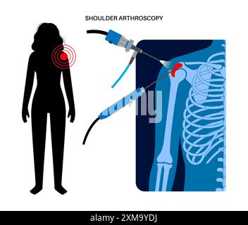 Illustration eines Schulterarthroskopieverfahrens. Dies ist ein Verfahren zur Diagnose und Behandlung von Gelenkproblemen. Ein Chirurg führt einen schmalen Schlauch, der an einer Glasfaser-Videokamera befestigt ist, durch einen kleinen Schnitt ein. Stockfoto