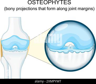 Osteophyt. Anatomie der menschlichen Kniegelenksarthrose. Knochensporne. Nahaufnahme eines Synovialgelenks mit Knorpeldegeneration. Osteophytenbildung. V Stock Vektor