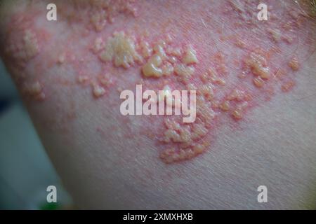 Gürtelrose Herpes zoster Hautausschlag Pusteln unter Armsicht Stockfoto