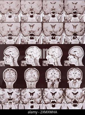 Magnetresonanztomographie des Kopfes eines gesunden Menschen, Bild der Hypophyse. Stockfoto