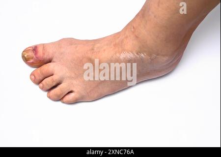 Nagelkrankheit. Zehennagel-Infektion. Nagelpilz. Von einem Menschen. Stockfoto