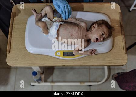 25 July 2024, Syrien, Atimah: Medizinische Fachkräfte führen Untersuchungen an einem Kind in einer Mangelernährungsklinik des HIHFAD-Krankenhauses in der Stadt Atimah durch. Die Bewohner der Lager im Nordwesten Syriens leiden unter schweren humanitären Bedingungen aufgrund eines Finanzierungsdefizits, was zur Einstellung der Verteilung von Nahrungskörben in den meisten Lagern und zu einer Zunahme von Unterernährungsfällen im Jahr 2024 im Vergleich zu den Vorjahren geführt hat. Einem OCHA-Bericht zufolge werden 50 % der Gesundheitseinrichtungen bis Dezember vollständig oder teilweise ihren Betrieb einstellen, und die Zahl der Menschen, die unter Ernährungsunsicherheit leiden, hat 3,6 Millionen erreicht Stockfoto