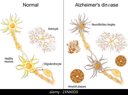 Alzheimer-Krankheit. Vergleich von Neuronen in einem gesunden Gehirn und Nervenzellen bei neurodegenerativen Erkrankungen. Demenz. Nahaufnahme von Neuronen mit Neurofi Stock Vektor