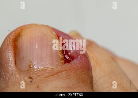 Nahaufnahme eines Zehens mit schweren Infektionen und Entzündungen, die ärztlich behandelt werden müssen Stockfoto