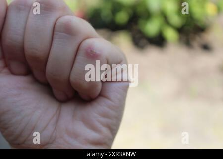 Ein Kallus an einem Finger in Nahaufnahme. Hände, die gepflegt werden müssen. Stockfoto