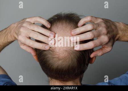 Kahlheit Männerkopf mit dünnen Haaren auf dem oberen Kopf nah oben. Haarausfall- und Alopezie-Konzept. Stockfoto