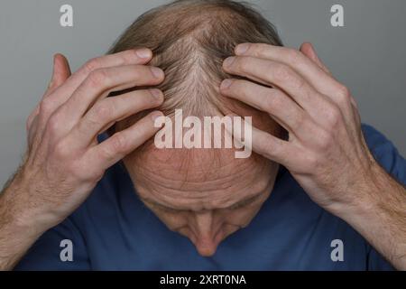 Glatzenmann, Rückansicht, Nahaufnahme des Kopfes Stockfoto