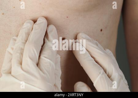 Dermatologe in Handschuhen zur Untersuchung des Muttermals des Patienten, Nahaufnahme Stockfoto
