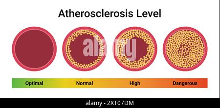 Atherosklerose-Thrombus-Gefässcholesterinspiegel-Arteria. Plaque-Herz-Thrombus-Herz-Kreislauf-System Blutvektor-Krankheit Illustration Stock Vektor