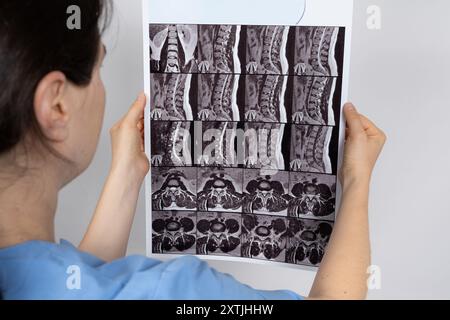 Der Arzt hält ein MRT-Bild eines Patienten mit Bandscheibenvorwölbung und Osteoarthritis der Brustwirbelsäule. Stockfoto