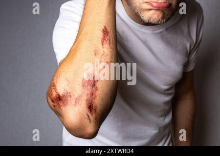 Mann mit einer großen Abriebwunde am Arm Stockfoto