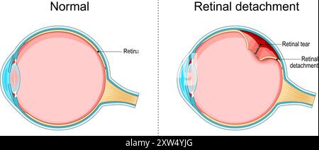 Netzhautablösung. Querschnitt eines normalen menschlichen Auges und Störung des Auges, bei dem sich die Netzhaut ablöst. Schematische Darstellung. Detaillierte Vektorillustr Stock Vektor