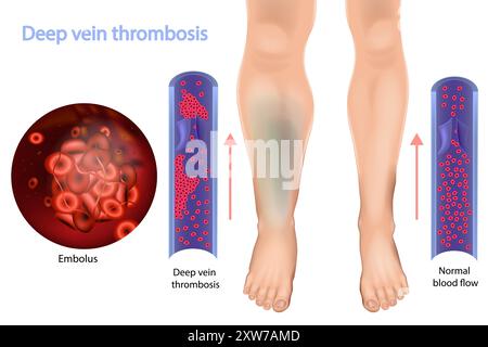 Tiefe Venenthrombose und normale Durchblutung. Ungewöhnliche Blutflut. Stock Vektor