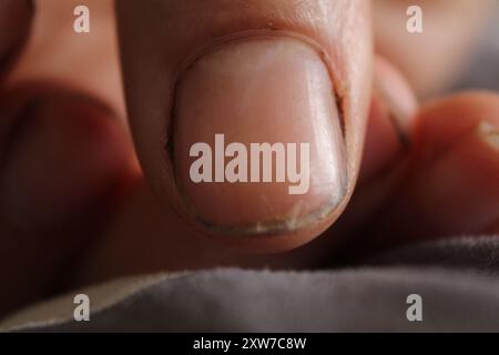 Beschädigter Nagelfinger an der Hand. Nahaufnahme eines beschädigten Nagels. Stockfoto
