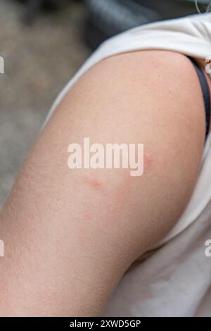 Mückenstiche auf die Scholle des Blonden Mädchens. Mädchen mit Mückenstichen auf der Schulter. Stockfoto