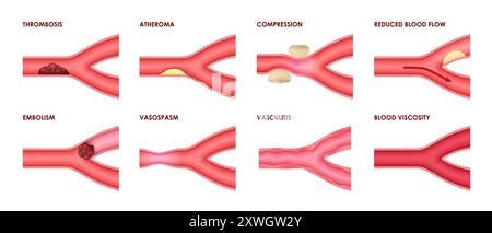 Venenerkrankungen von Thrombose, Atherom und Vaskulitis mit Blutviskosität, vektormedizinische Infografik-Ikonen. Venenerkrankungen der Gefäßarterienkompression, Vasospasmus, Embolie und verminderter Blutfluss Stock Vektor