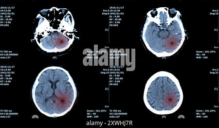 MRT-Scan Gehirn, ct-Scan des Hirnbildes zur Diagnose Blutung, Tumor. Stockfoto