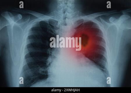 Lungenkrebs. Röntgenbild der Lunge des Patienten zum Lungentumor. Stockfoto