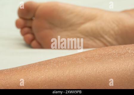 Nahaufnahme des weiblichen Beines und barfuß mit abziehender Haut. Dermatologische Gesundheit und Hautpflegekonzept. Stockfoto