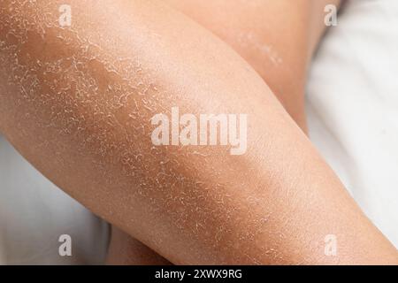 Detailmakro der trockenen Haut der Frauenbeine. Nahaufnahme von Dehydratation durch Sonnenstrahlen ohne Sonnenschutzcreme Stockfoto