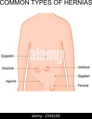 Hernientypen. Häufige Hernien. Schematische Darstellung. Detaillierte Vektordarstellung Stock Vektor