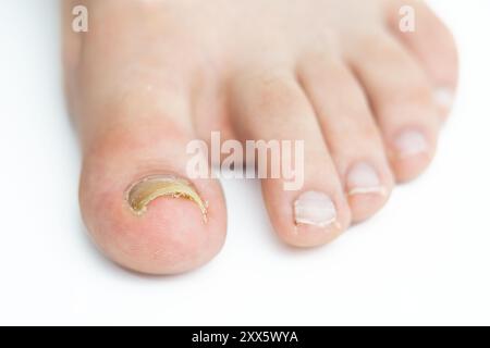 Männlicher Fuß mit Nagelpilzinfektion isoliert auf weißem Hintergrund Stockfoto