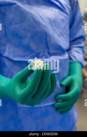 Herzklappenchirurgie Kardiologie für Patienten im Krankenhaus. Transkatheter-Aortenklappenimplantation in der Hand des Arztes vorbereiten. Herzklappe Stockfoto