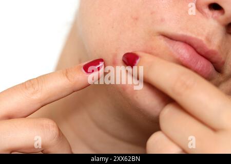 Nahaufnahme des weiblichen Gesichts mit rot problematischer Aknehaut und Narben Stockfoto