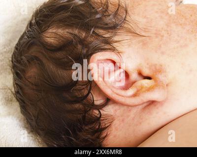 Neugeborenes Baby mit vielen dunklen Haaren, rotem und gelbem Ausschlag auf Ohr und Gesicht Stockfoto