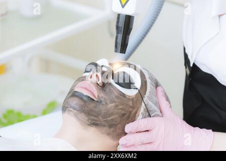 Close-up-Verfahren zur Kohleabscheidung. Laserimpulse reinigen die Gesichtshaut. Hardware-kosmetologische Behandlung. Prozess der Photothermolyse, Erwärmung der Stockfoto