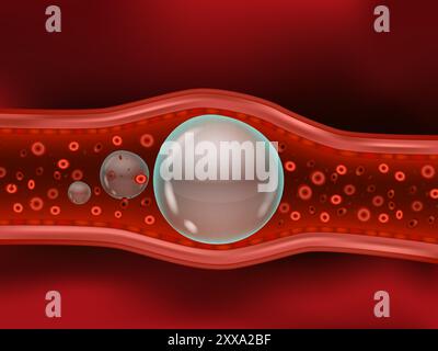 Eine Luftembolie, auch Gasembolie genannt. Stock Vektor