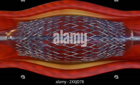 Ein 3D-Rendering eines Stents in einer Blutkapillare kann das Verfahren visualisieren. Die Angioplastie ist ein Verfahren zum Öffnen verengter oder blockierter Blutgefäße. Stockfoto