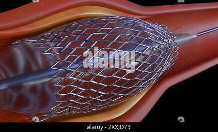 Ein 3D-Rendering eines Stents in einer Blutkapillare kann das Verfahren visualisieren. Die Angioplastie ist ein Verfahren zum Öffnen verengter oder blockierter Blutgefäße. Stockfoto