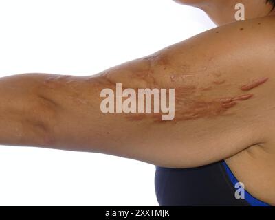 Gewaltige Operationsnarben durch Operation an einem gebrochenen Arm infolge eines Verkehrsunfalls Stockfoto