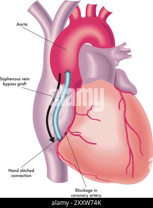 Illustration einer Koronararterien-Bypass-Transplantation mit Anmerkungen. Stock Vektor