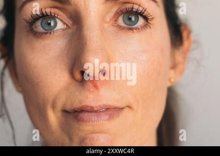 Porträt einer Frau mit Herpesschmerzen unter der Nase Stockfoto