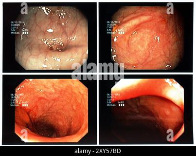 Koloskopie Stockfoto