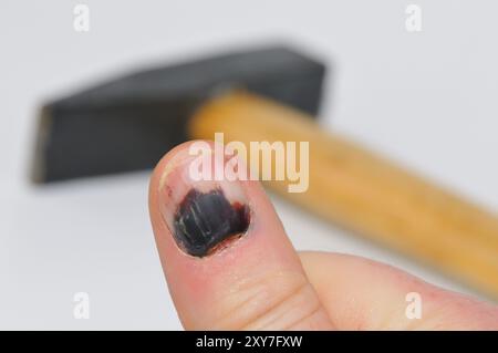 Blauer Fingernagel nach einem falschen Hammerschlag. Frau mit blauem Fingernagel und Hammer Stockfoto