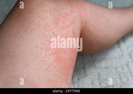 Allergischer Hautausschlag am Bein. Photodermatitis. Allergie gegen die Sonne, Ultraviolett. Roter Hautausschlag. Stockfoto