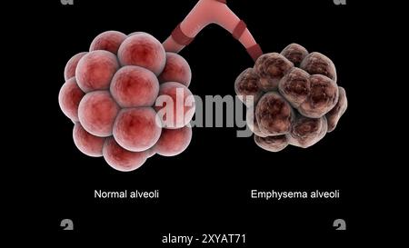 Medizinischer Vergleich gesunder Alveolen und eines ungesunden Emphysema alveoli Stockfoto