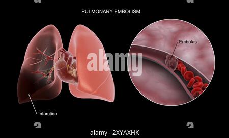 Medizinisches Konzept zur Lungenembolie in der menschlichen Lunge Stockfoto