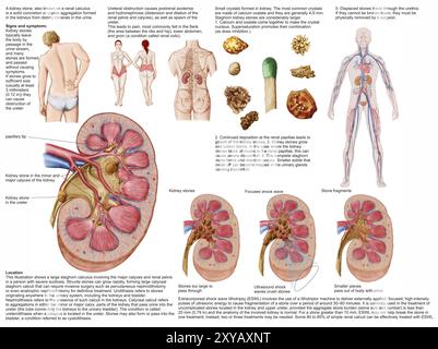 Medizinische Tabelle, die die Anzeichen und Symptome von Nierensteinen zeigt Stockfoto