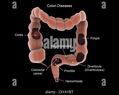 Medizinische Illustration, die Arten von Darmerkrankungen zeigt Stockfoto