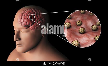 Biomedizinische Darstellung der östlichen Pferdeenzephalitis im Gehirn mit vergrößertem Schnitt Stockfoto