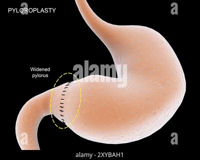 Medizinische Illustration der Pyloroplastik, die den Pylorus im Magen verbreitert Stockfoto