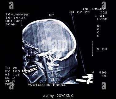 Medizinische Radiographie. Röntgenbild des menschlichen Kopfes im Profil. Stockfoto