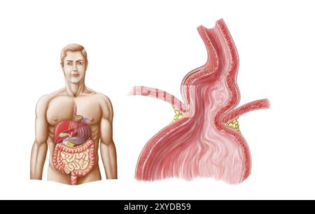 Die medikamentöse Annierung einer Hiatushernie im oberen Magenbereich in den Thorax Stockfoto