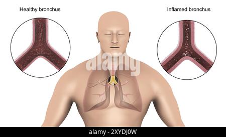 Medizinische Illustration der Bronchitis in der menschlichen Lunge Stockfoto