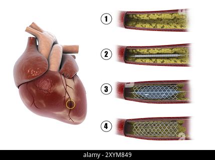 Diagramm zur Darstellung des Verfahrens der Ballonangioplastie zur Verbreiterung der versperrten Arterien im Herzen Stockfoto