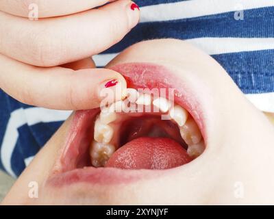 Nahaufnahme eines Fingers, der einen verlorenen Zahn im Mund eines kleinen Mädchens spürt Stockfoto